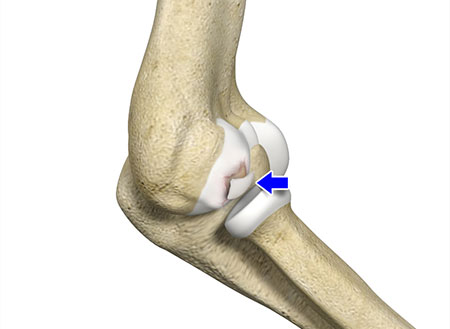 Osteochondritis Dissecans of the Elbow